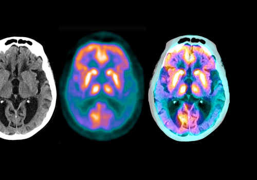The Most Promising Treatments for Alzheimer's Disease: A Closer Look